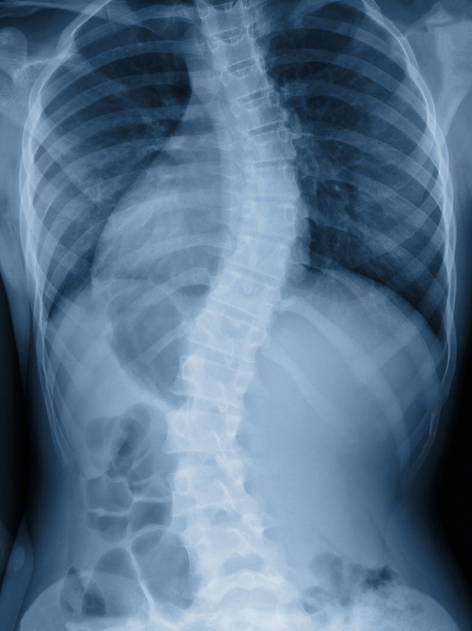 Scoliosis2