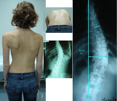 scoliosis